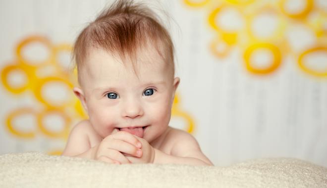 down syndrome infant